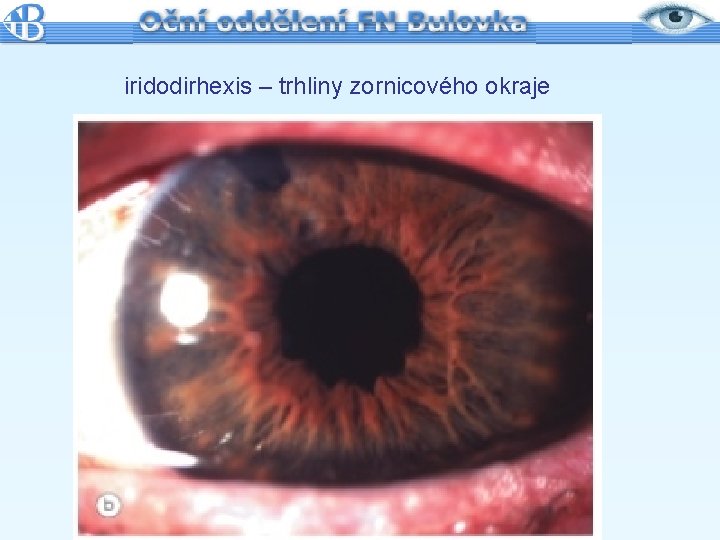 iridodirhexis – trhliny zornicového okraje 
