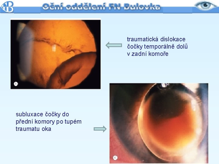 traumatická dislokace čočky temporálně dolů v zadní komoře subluxace čočky do přední komory po