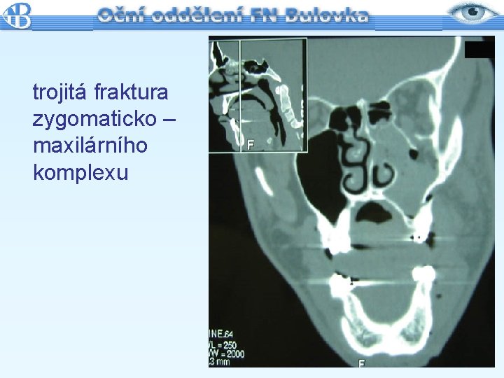 trojitá fraktura zygomaticko – maxilárního komplexu 