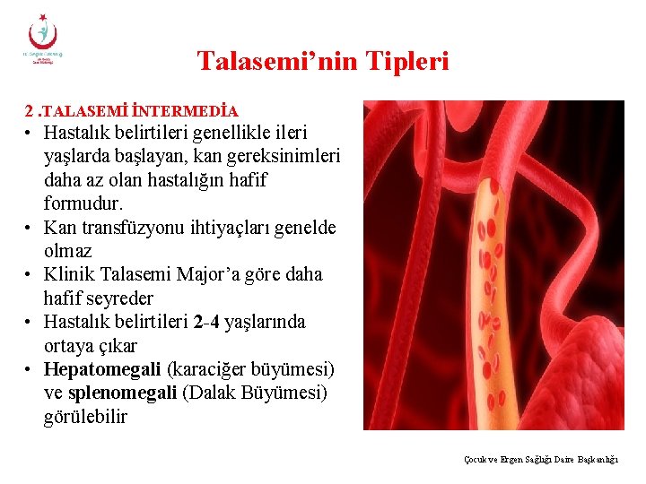 Talasemi’nin Tipleri 2. TALASEMİ İNTERMEDİA • Hastalık belirtileri genellikle ileri yaşlarda başlayan, kan gereksinimleri