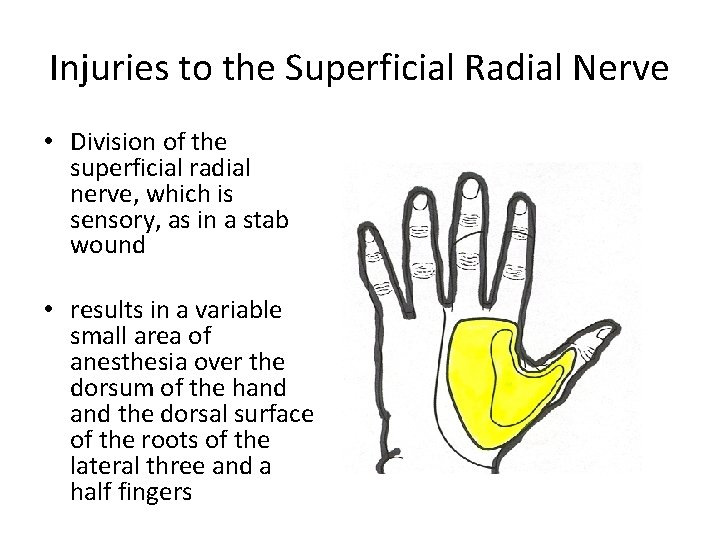 Injuries to the Superficial Radial Nerve • Division of the superficial radial nerve, which