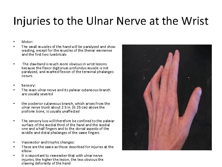 Injuries to the Ulnar Nerve at the Wrist • • Motor: The small muscles