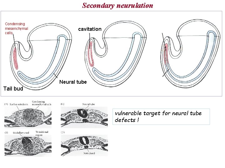 Secondary neurulation Condensing mesenchymal cells cavitation Neural tube Tail bud vulnerable target for neural