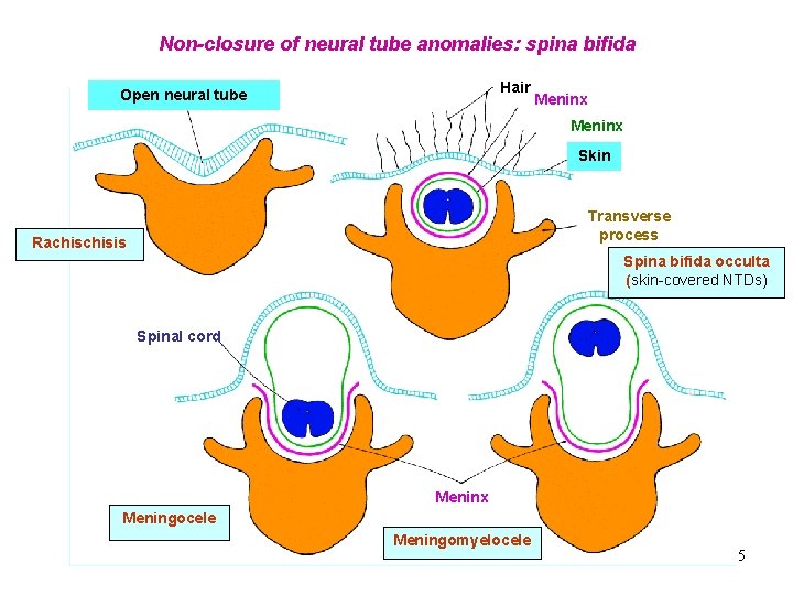 Non-closure of neural tube anomalies: spina bifida Hair Open neural tube Meninx Skin Transverse