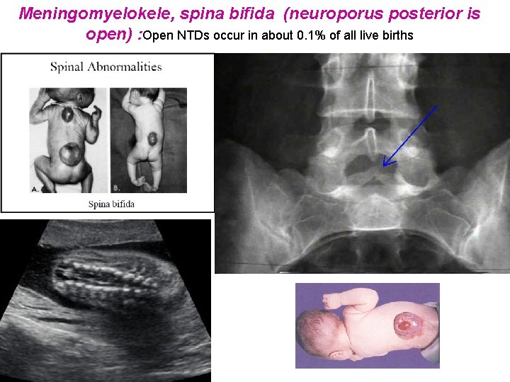 Meningomyelokele, spina bifida (neuroporus posterior is open) : Open NTDs occur in about 0.