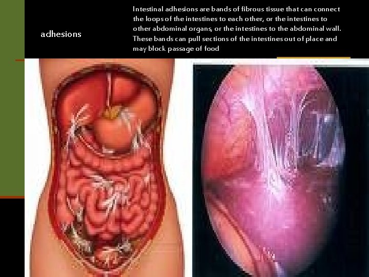 adhesions Intestinal adhesions are bands of fibrous tissue that can connect the loops of