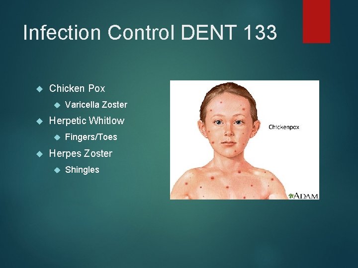 Infection Control DENT 133 Chicken Pox Herpetic Whitlow Varicella Zoster Fingers/Toes Herpes Zoster Shingles