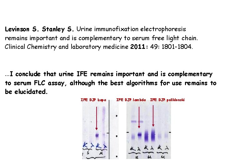 Levinson S. Stanley S. Urine immunofixation electrophoresis remains important and is complementary to serum