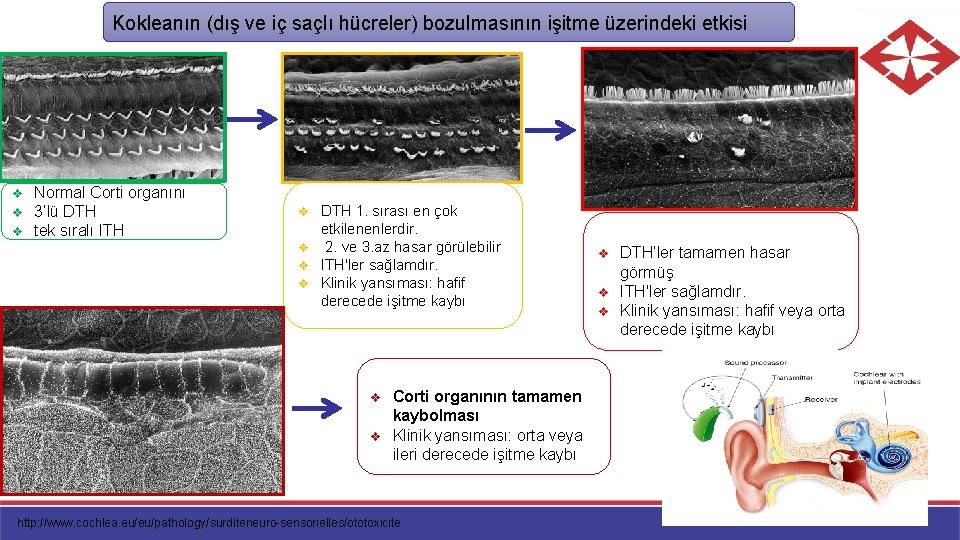 Kokleanın (dış ve iç saçlı hücreler) bozulmasının işitme üzerindeki etkisi v Normal Corti organını