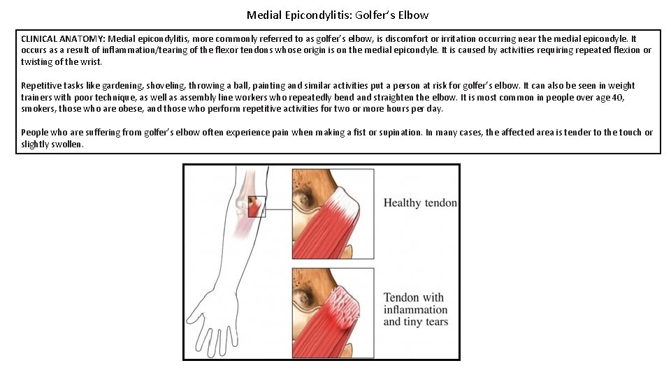 Medial Epicondylitis: Golfer’s Elbow CLINICAL ANATOMY: Medial epicondylitis, more commonly referred to as golfer’s