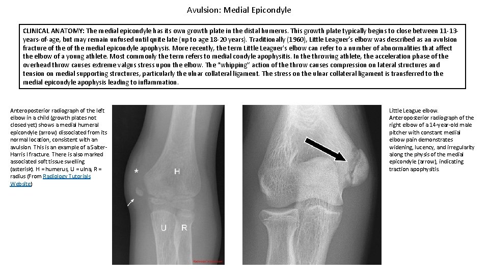 Avulsion: Medial Epicondyle CLINICAL ANATOMY: The medial epicondyle has its own growth plate in