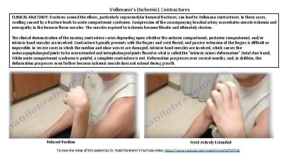 Volkmann’s (Ischemic) Contractures CLINICAL ANATOMY: Fractures around the elbow, particularly supracondylar humeral fractures, can
