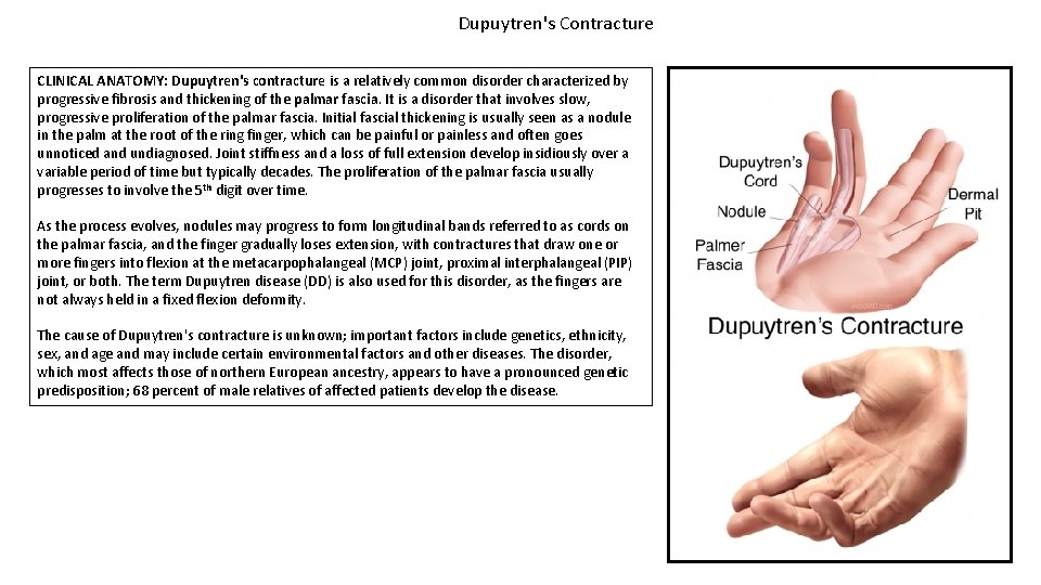 Dupuytren's Contracture CLINICAL ANATOMY: Dupuytren's contracture is a relatively common disorder characterized by progressive