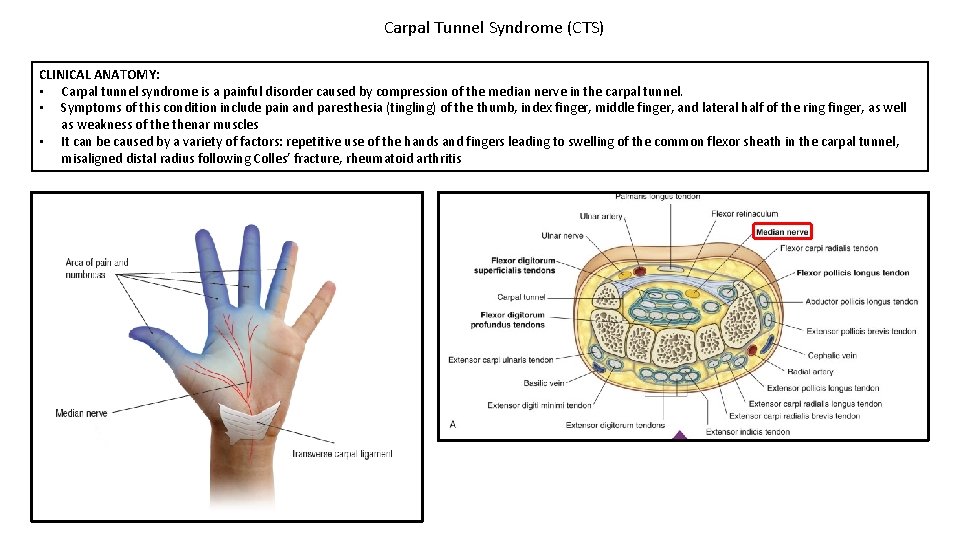 Carpal Tunnel Syndrome (CTS) CLINICAL ANATOMY: • Carpal tunnel syndrome is a painful disorder