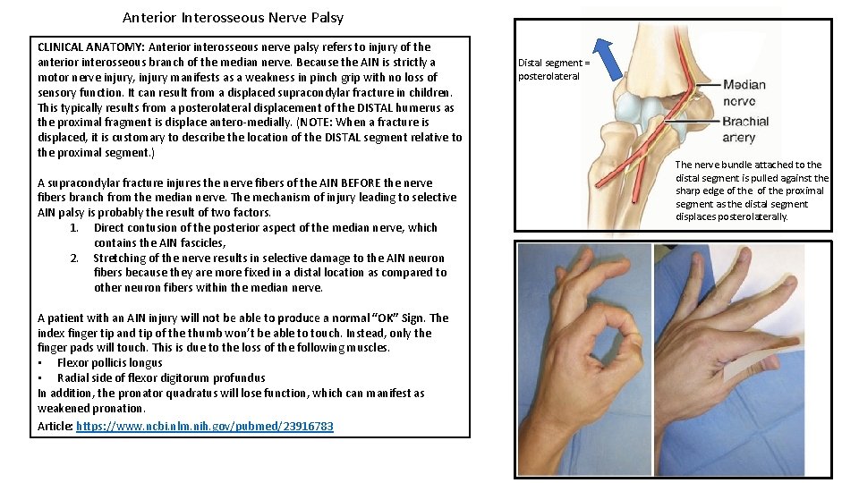 Anterior Interosseous Nerve Palsy CLINICAL ANATOMY: Anterior interosseous nerve palsy refers to injury of