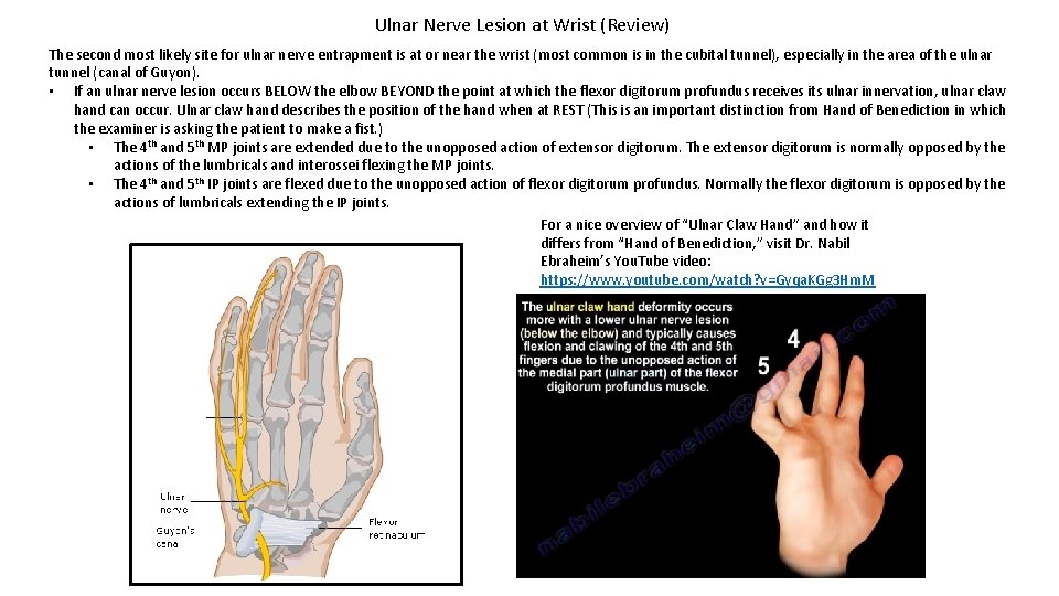 Ulnar Nerve Lesion at Wrist (Review) The second most likely site for ulnar nerve