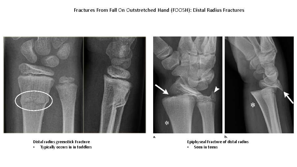 Fractures From Fall On Outstretched Hand (FOOSH): Distal Radius Fractures Distal radius greenstick Fracture