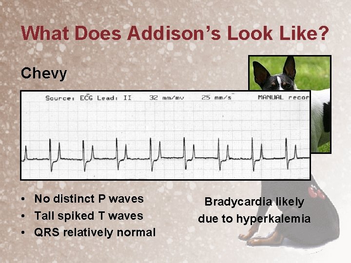 What Does Addison’s Look Like? Chevy • • • No distinct P waves Tall