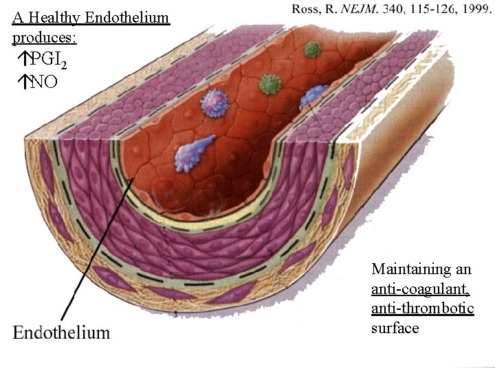 A Healthy Endothelium produces: áPGI 2 áNO Maintaining an anti-coagulant, anti-thrombotic surface 