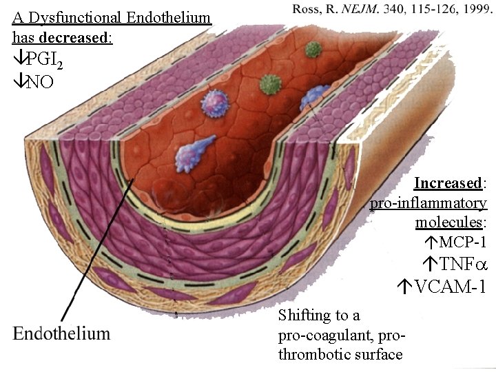 A Dysfunctional Endothelium has decreased: âPGI 2 âNO Increased: pro-inflammatory molecules: áMCP-1 áTNF áVCAM-1