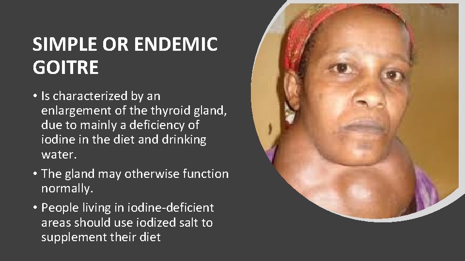 SIMPLE OR ENDEMIC GOITRE • Is characterized by an enlargement of the thyroid gland,