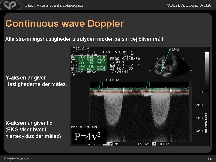 Ekko 1 – kursus i basal ekkokardiografi © Dansk Cardiologisk Selskab Continuous wave Doppler