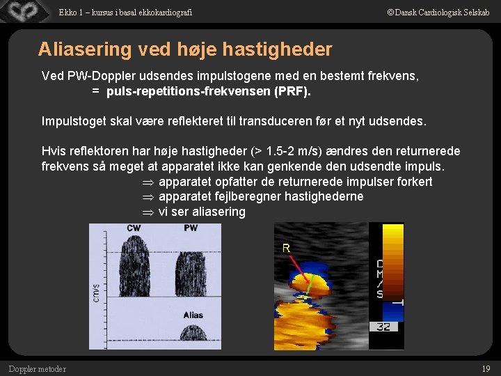 Ekko 1 – kursus i basal ekkokardiografi © Dansk Cardiologisk Selskab Aliasering ved høje