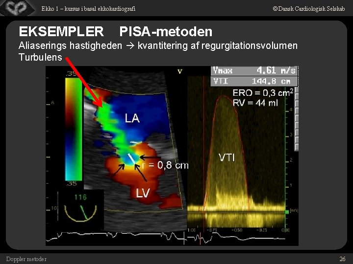 Ekko 1 – kursus i basal ekkokardiografi EKSEMPLER © Dansk Cardiologisk Selskab PISA-metoden Aliaserings