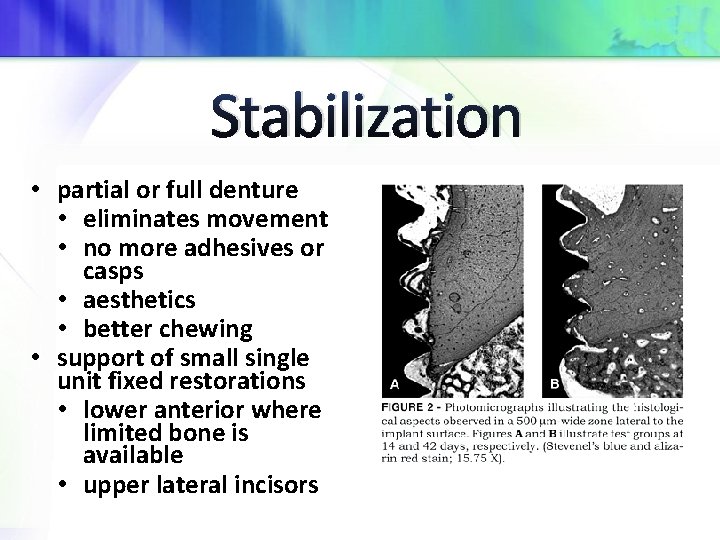 Stabilization • partial or full denture • eliminates movement • no more adhesives or