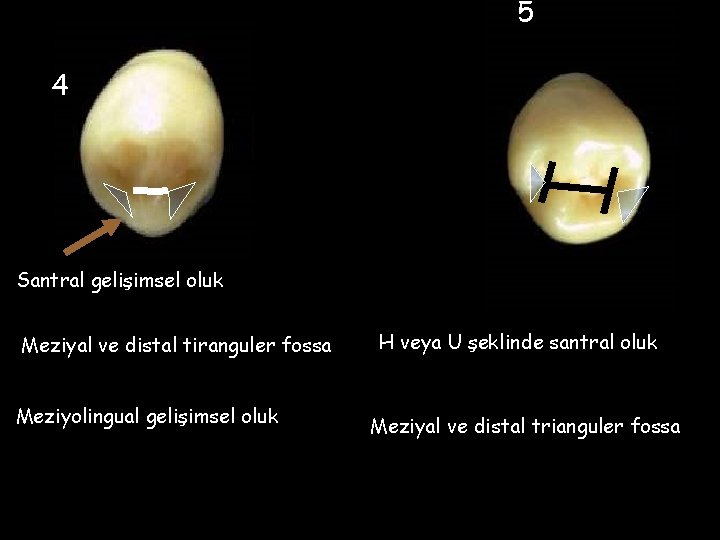 5 4 Santral gelişimsel oluk Meziyal ve distal tiranguler fossa Meziyolingual gelişimsel oluk H