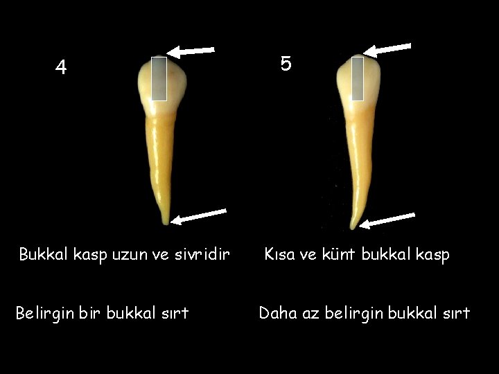 4 5 Bukkal kasp uzun ve sivridir Kısa ve künt bukkal kasp Belirgin bir