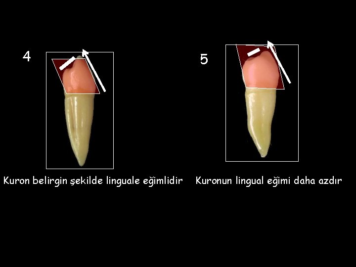 4 Kuron belirgin şekilde linguale eğimlidir 5 Kuronun lingual eğimi daha azdır 