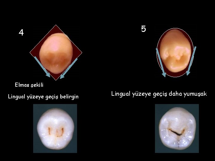 4 5 Elmas şekili Lingual yüzeye geçiş belirgin Lingual yüzeye geçiş daha yumuşak 