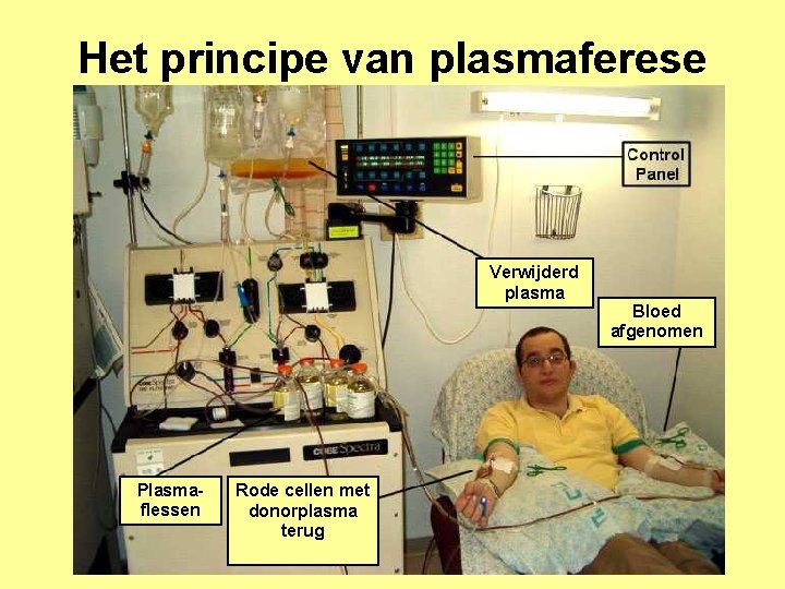 Het principe van plasmaferese Verwijderd plasma Plasmaflessen Rode cellen met donorplasma terug Bloed afgenomen