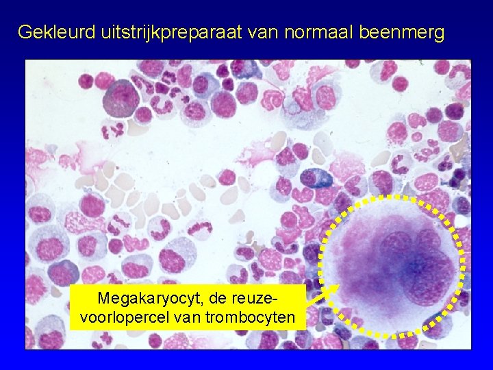 Gekleurd uitstrijkpreparaat van normaal beenmerg Megakaryocyt, de reuzevoorlopercel van trombocyten 