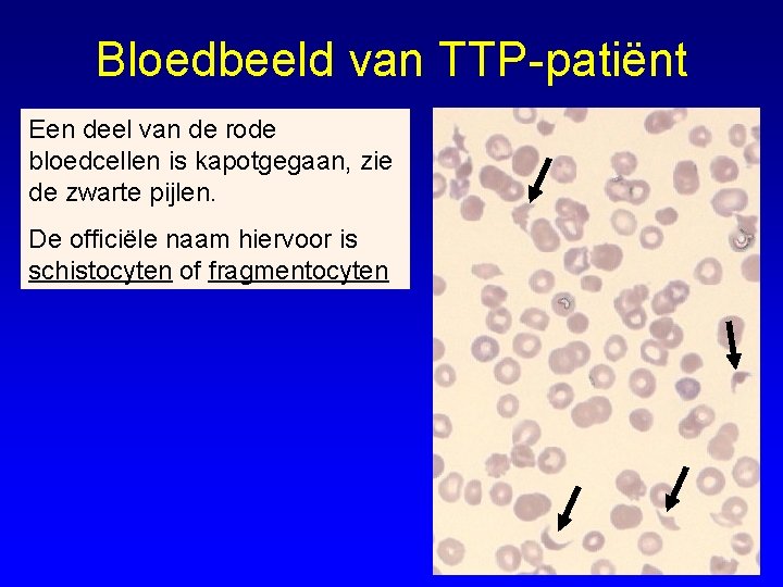 Bloedbeeld van TTP-patiënt Een deel van de rode bloedcellen is kapotgegaan, zie de zwarte