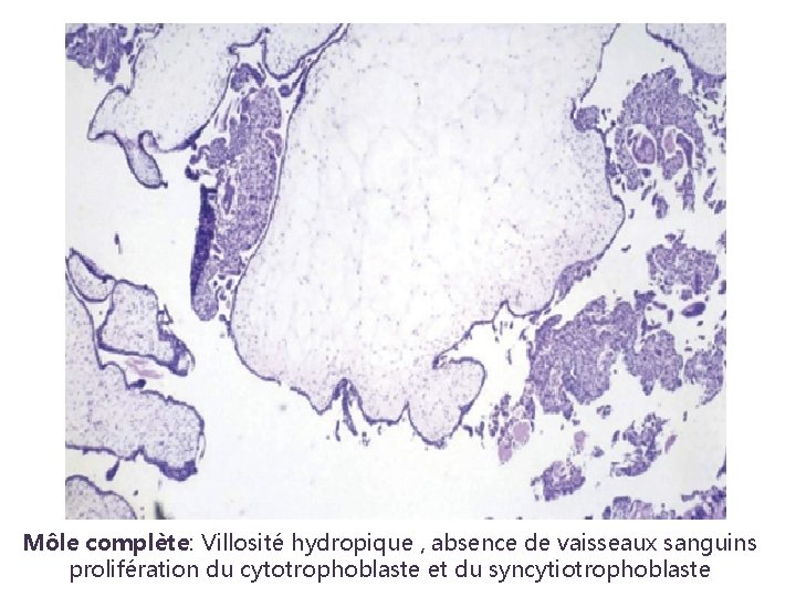 Môle complète: Villosité hydropique , absence de vaisseaux sanguins prolifération du cytotrophoblaste et du