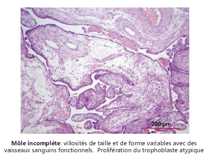 Môle incomplète: villosités de taille et de forme variables avec des vaisseaux sanguins fonctionnels.