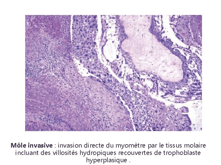 Môle invasive : invasion directe du myomètre par le tissus molaire incluant des villosités