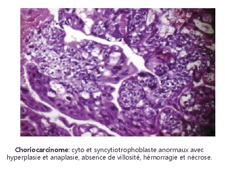 Choriocarcinome: cyto et syncytiotrophoblaste anormaux avec hyperplasie et anaplasie, absence de villosité, hémorragie et