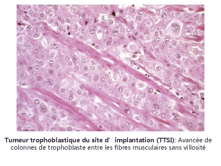 Tumeur trophoblastique du site d’implantation (TTSI): Avancée de colonnes de trophoblaste entre les fibres