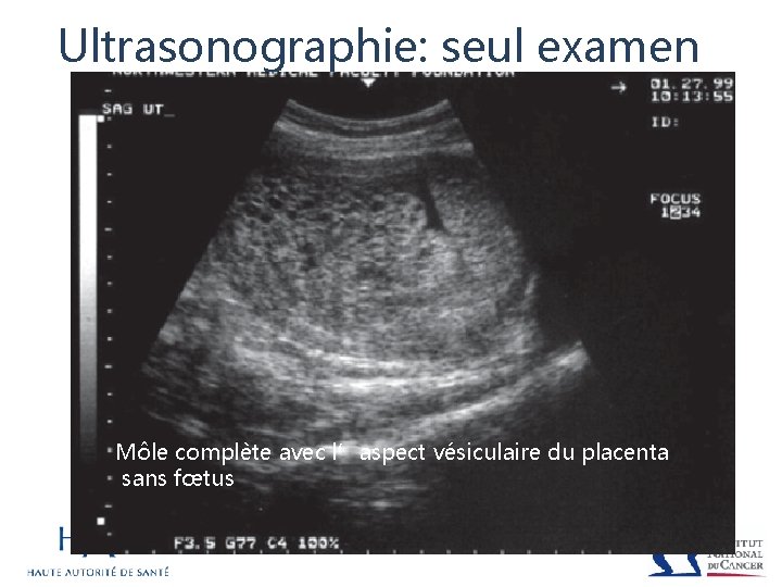Ultrasonographie: seul examen Môle complète avec l’aspect vésiculaire du placenta sans fœtus 