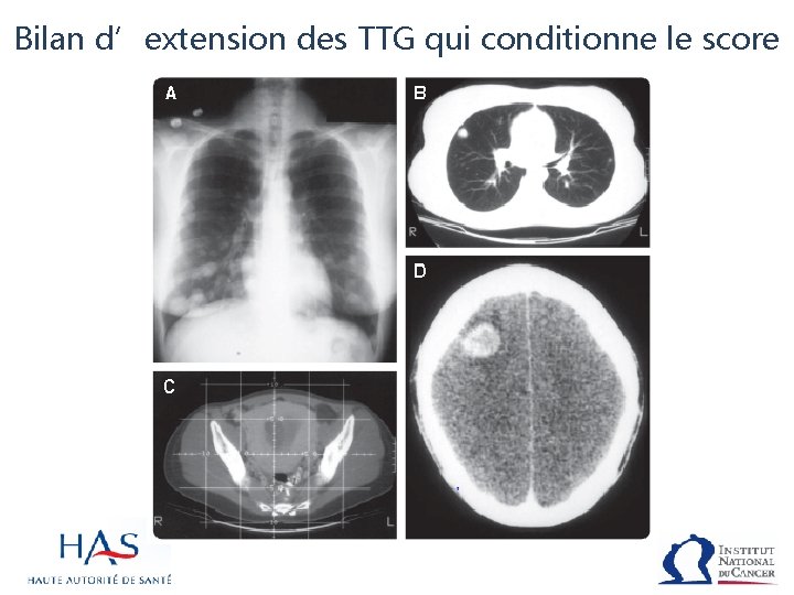 Bilan d’extension des TTG qui conditionne le score 