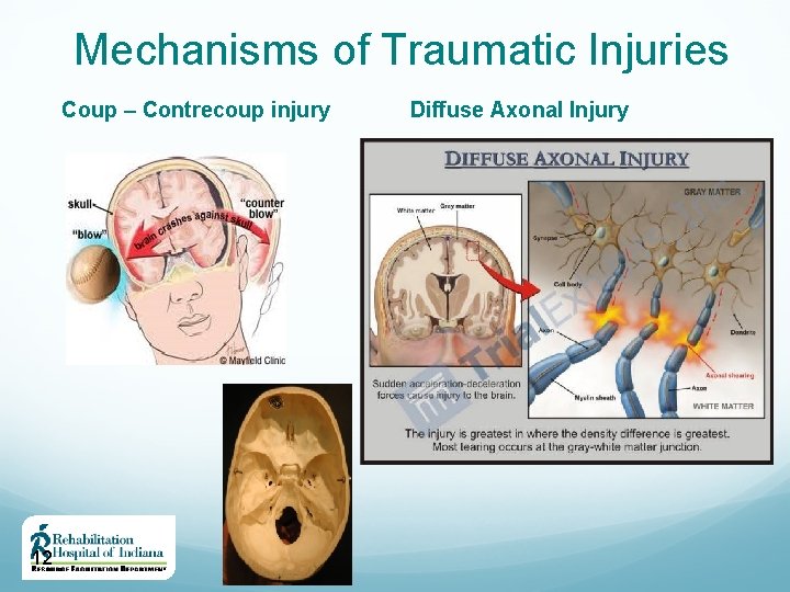 Mechanisms of Traumatic Injuries Coup – Contrecoup injury 12 Diffuse Axonal Injury 