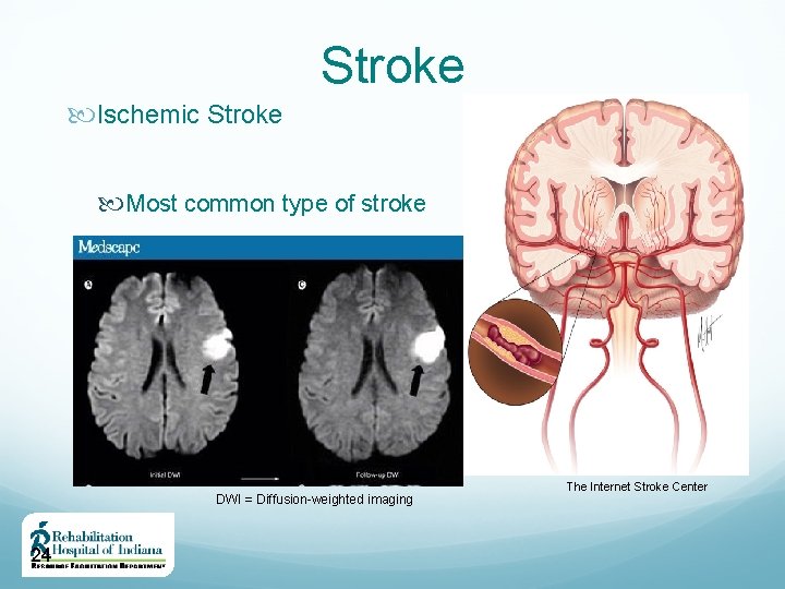 Stroke Ischemic Stroke Most common type of stroke DWI = Diffusion-weighted imaging 24 The