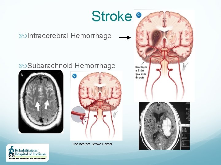 Stroke Intracerebral Hemorrhage Subarachnoid Hemorrhage The Internet Stroke Center 25 
