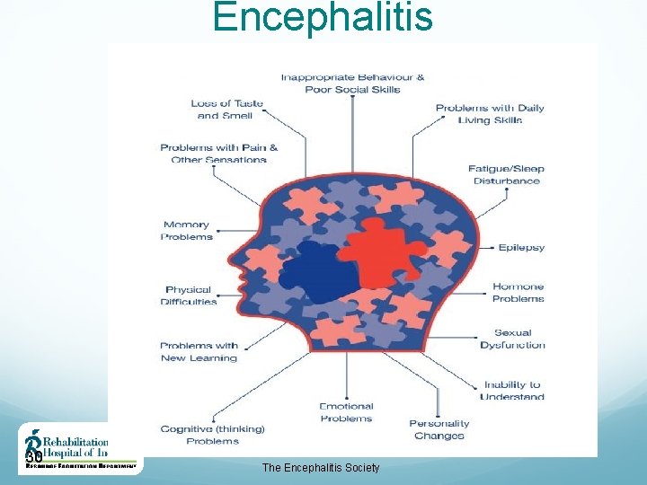 Encephalitis 30 The Encephalitis Society 
