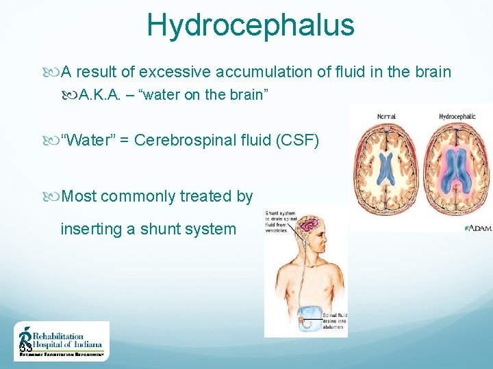 Hydrocephalus A result of excessive accumulation of fluid in the brain A. K. A.