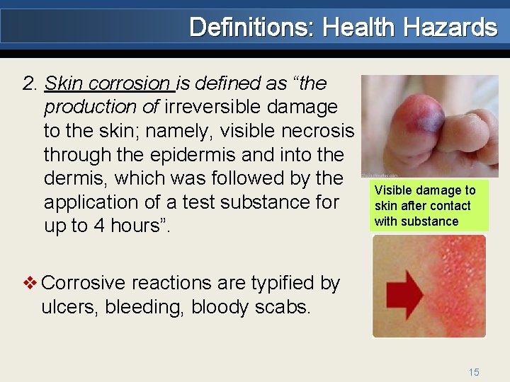 Definitions: Health Hazards 2. Skin corrosion is defined as “the production of irreversible damage