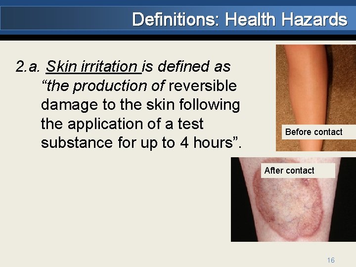 Definitions: Health Hazards 2. a. Skin irritation is defined as “the production of reversible